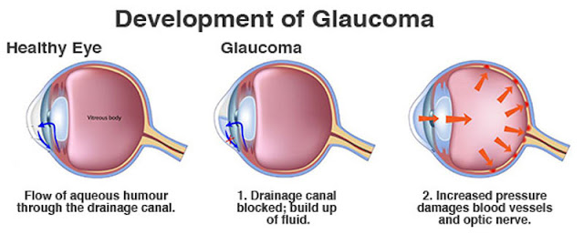 Glaucoma progression chart