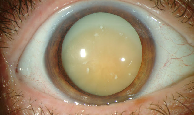 MAture Cataract