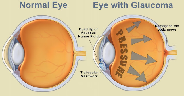 Ocular Hypertension