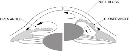 Open Angle Versus Angle Closure glaucoma angle
