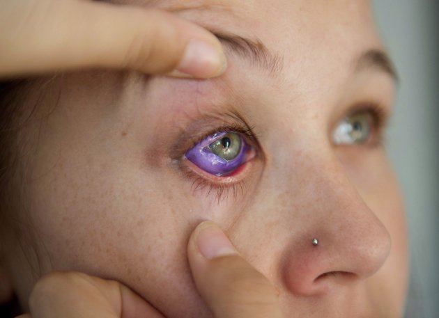 eye tattooing that went horribly wrong