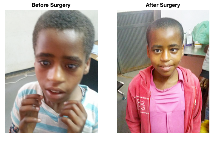 before and after childhood blindness