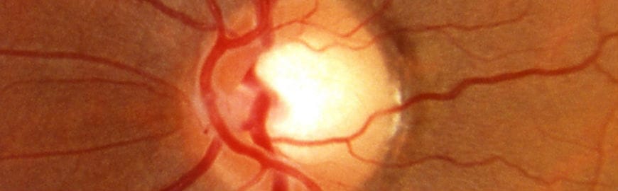 optic disc damage in glaucoma