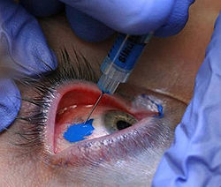 Scleral Tattoo in eye, eye tattoo gone wrong