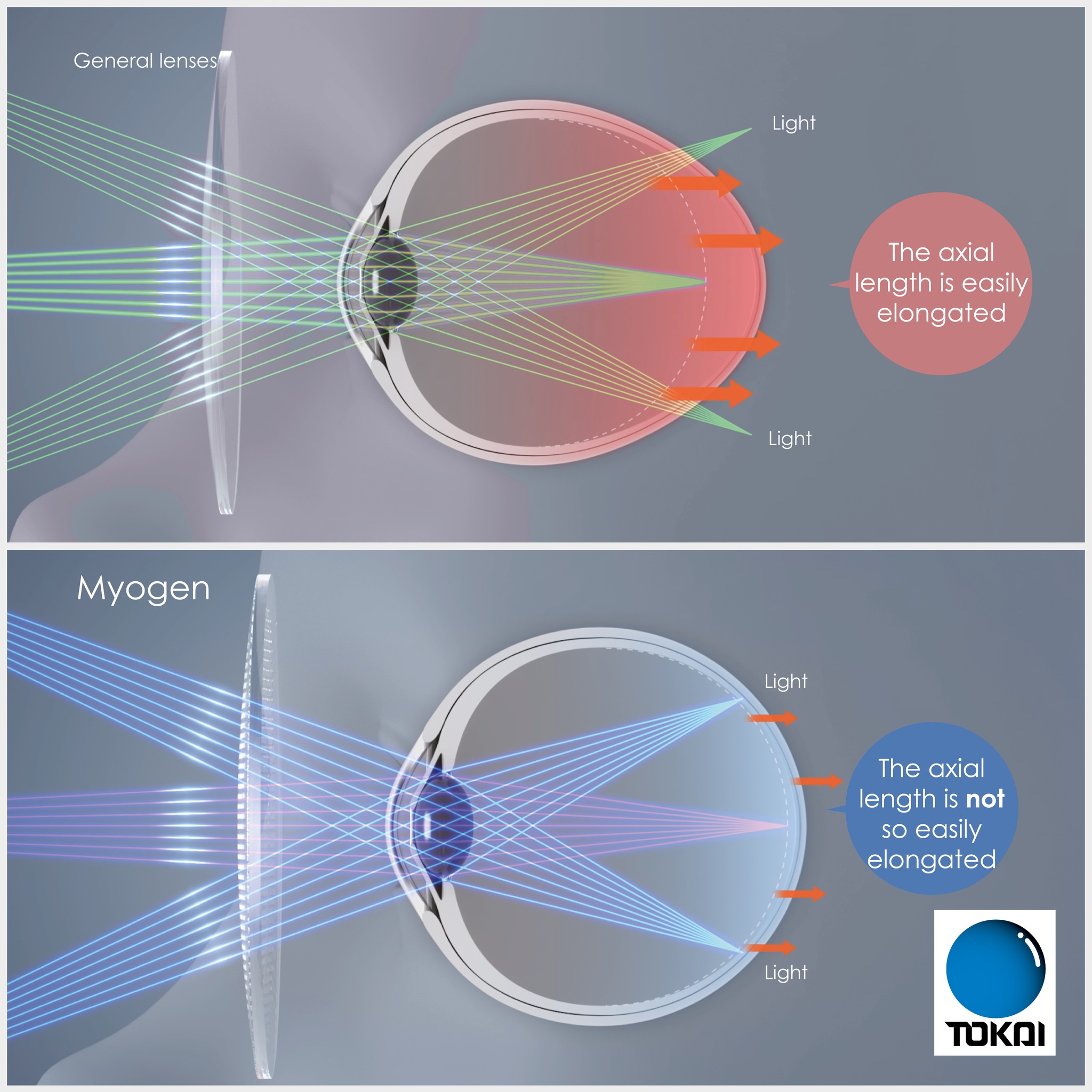 General lens vs Myogen myopia control lens